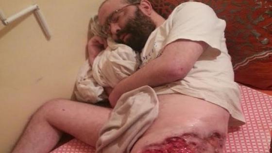 مرض نادر يحول فخذ شاب إلى “رقعة حفر” بالدشيرة الجهادية